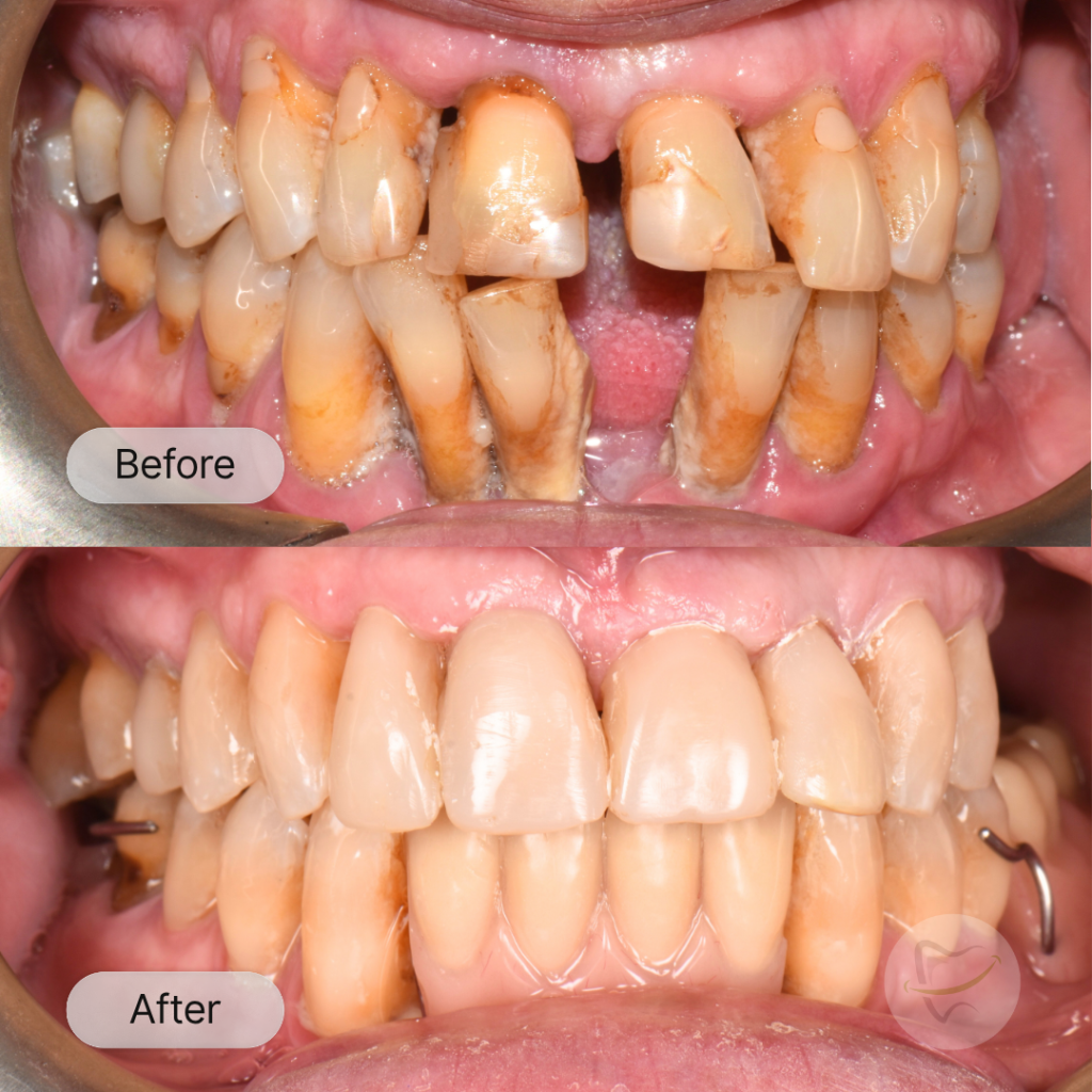 M: Gum treatment, Veneers and dentures, after 8 weeks