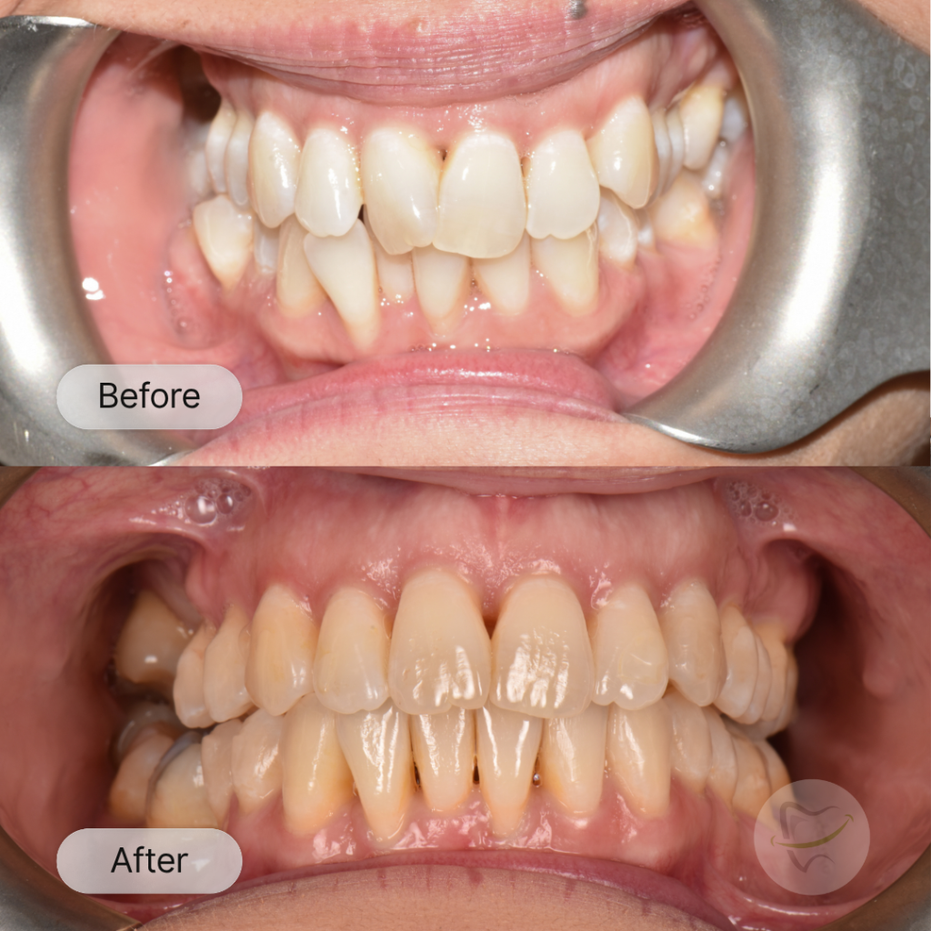 MG: Invisalign, after 21 months