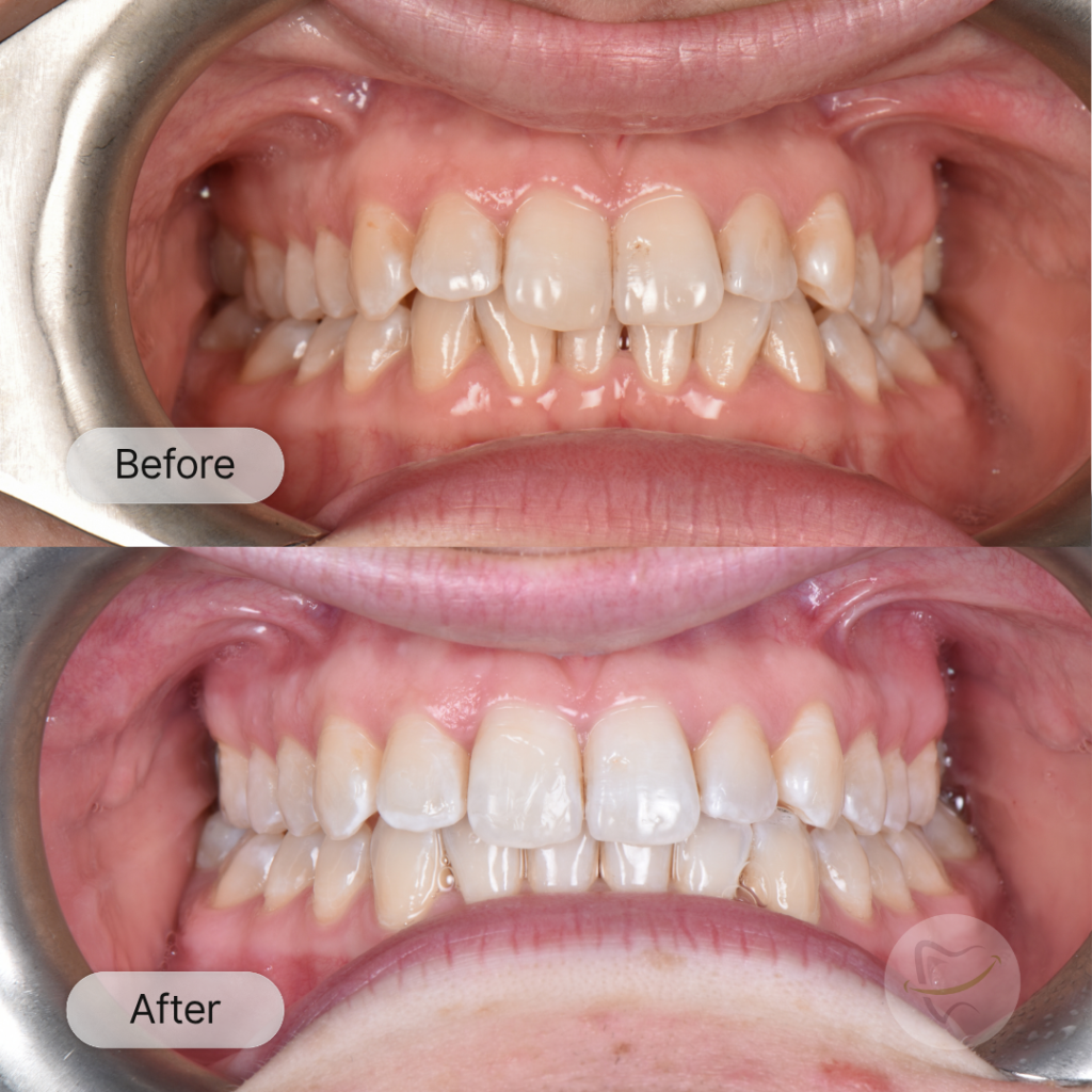 Maria: Invisalign and Whitening, after 12 months