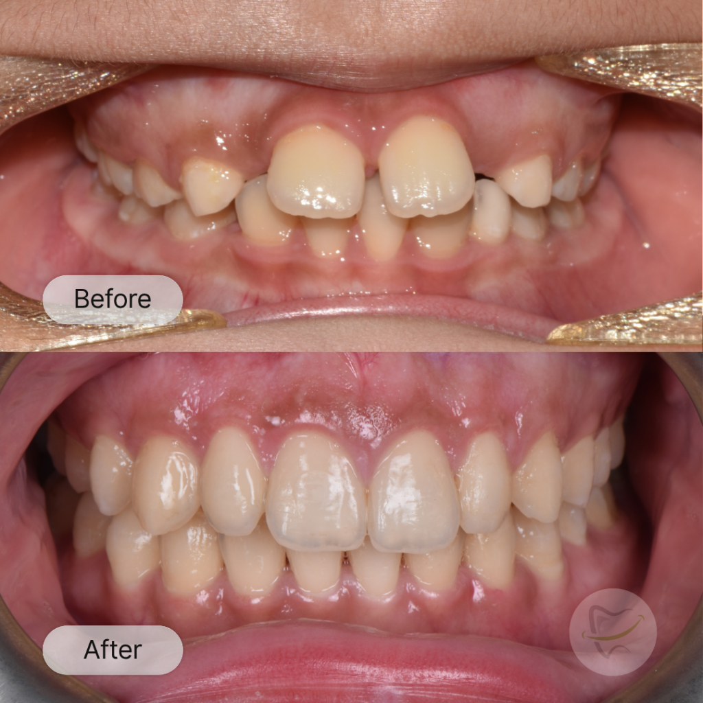 Ny Braces In Liberty Dental after 8-12 months