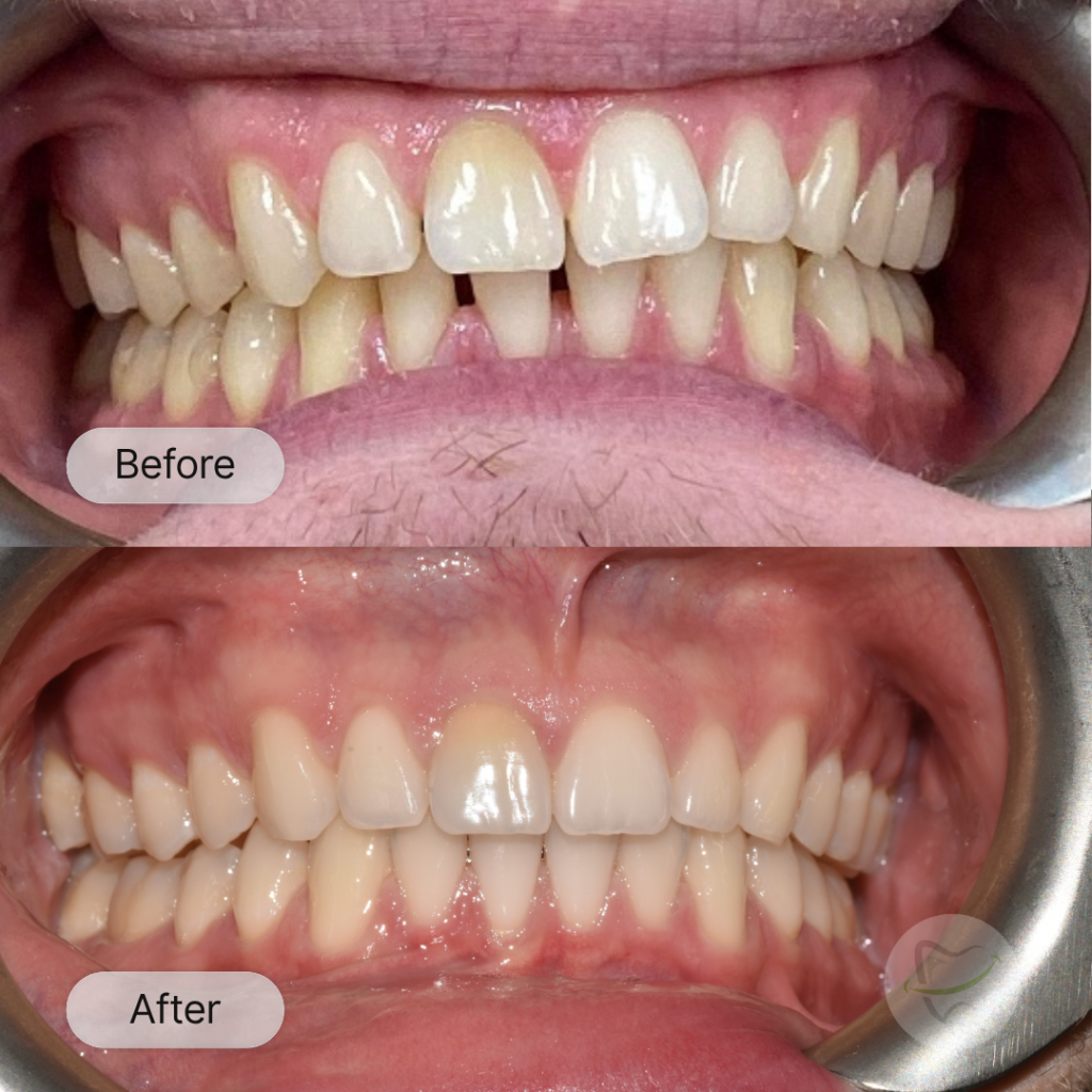 NH: Invisalign, after 13 months