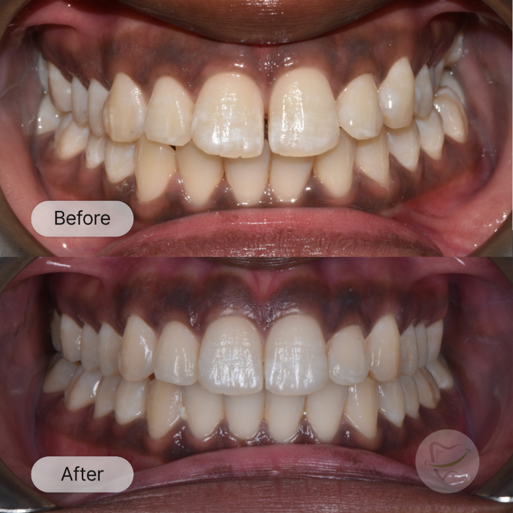 NS: Invisalign, after 10 months