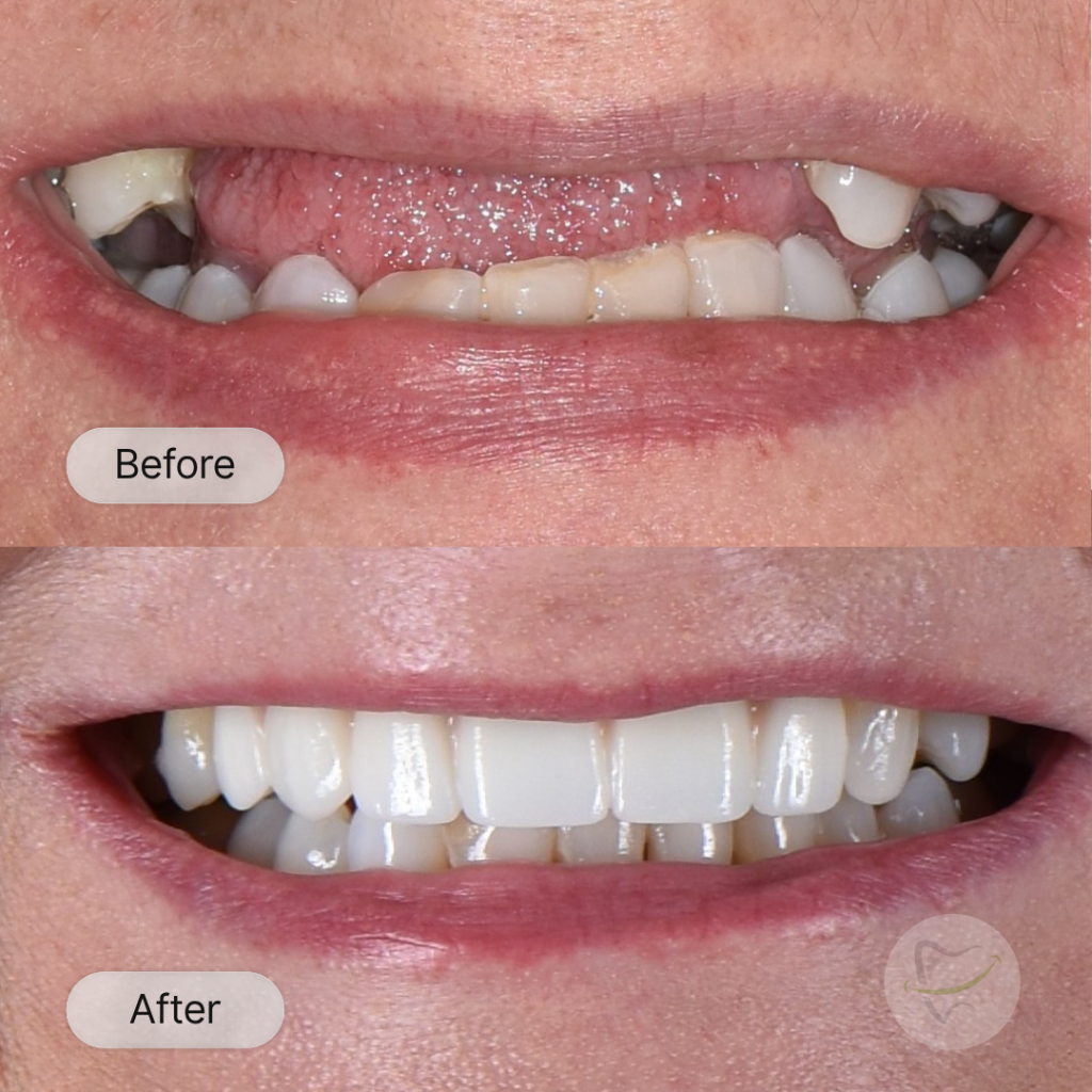 PR: Implant bridge, after 6 months