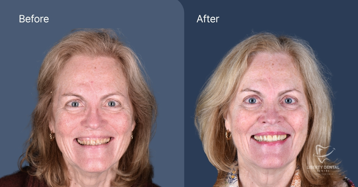 Rachel Of Clayton's Porcelain Veneers And Laser Gum Smile Makeover after 2 weeks