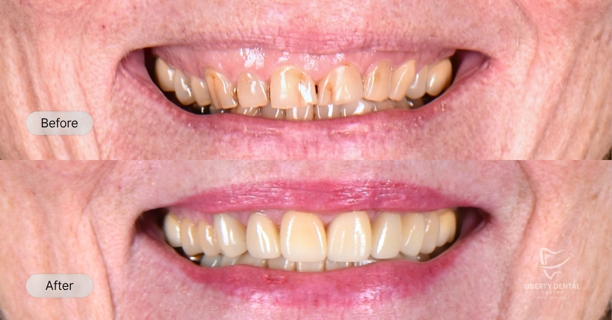 Rachel Of Clayton's Porcelain Veneers And Laser Gum Smile Makeover