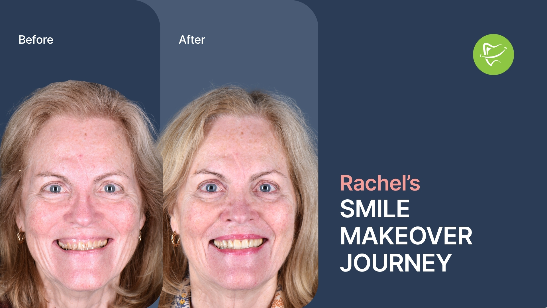 Smile Makeover Clayton: Rachel’s Smile Transformation with Porcelain Veneers and Laser Gum Treatment at Liberty Dental
