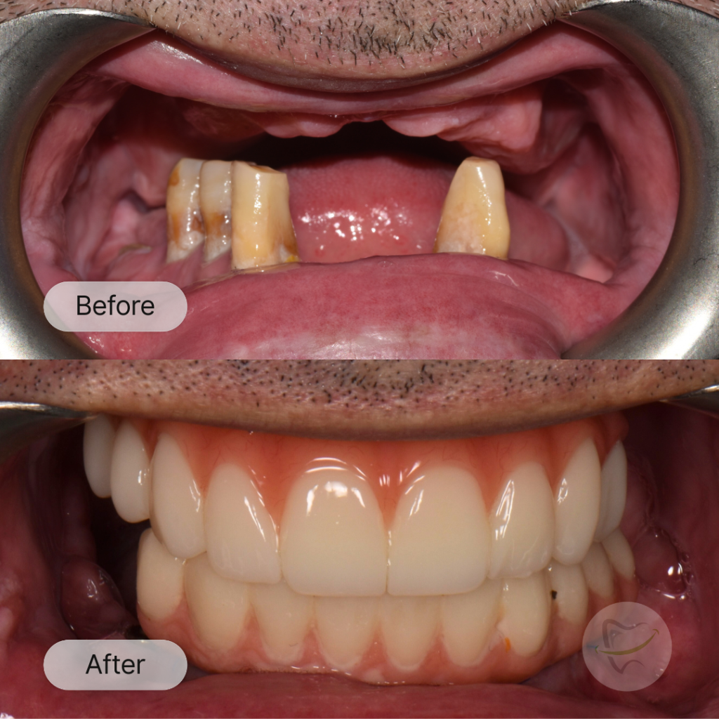 SR - Upper Denture, Lower All-On-X after 16 weeks