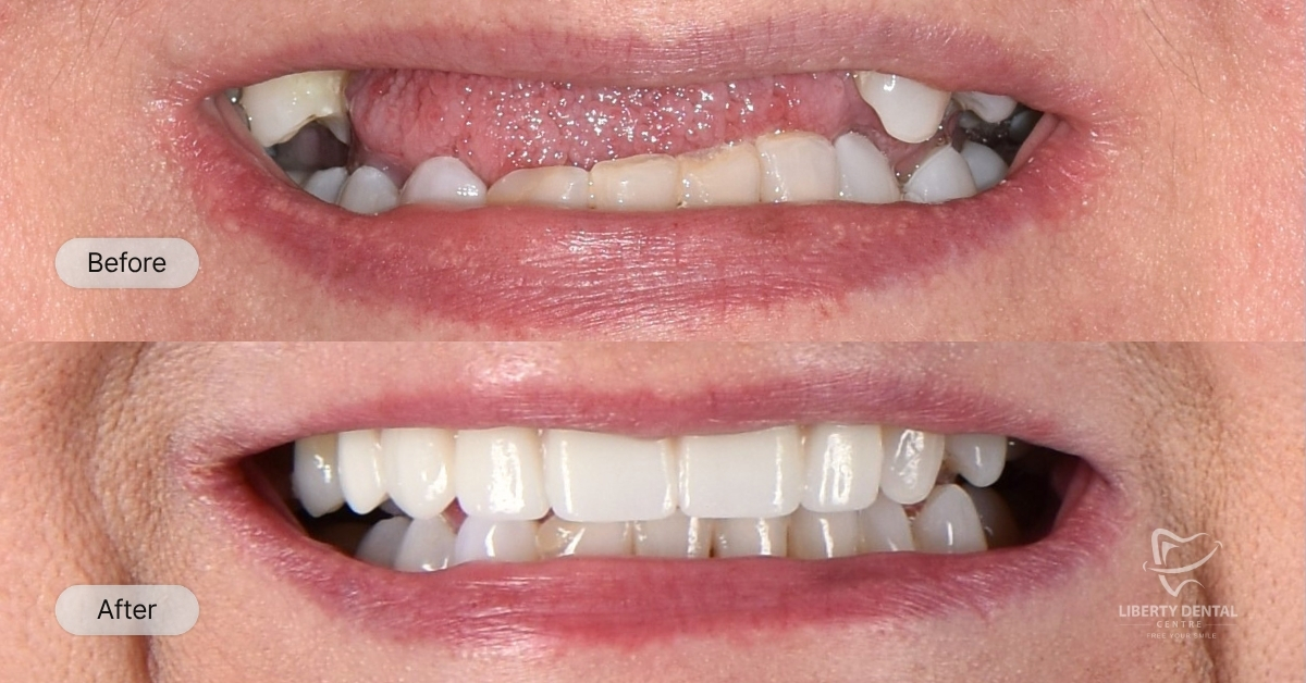 Rosie Of Ferntree Gully's Dental Implants Smile Makeover after 12-15 weeks