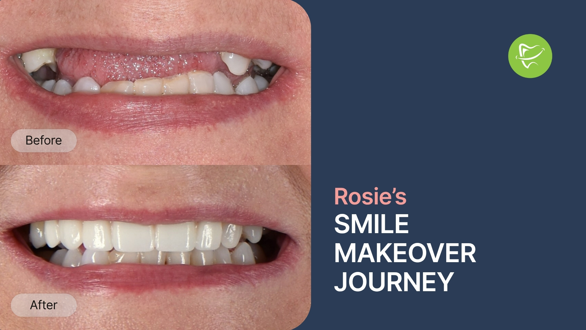 Rosie Of Ferntree Gully's Dental Implants Smile Makeover