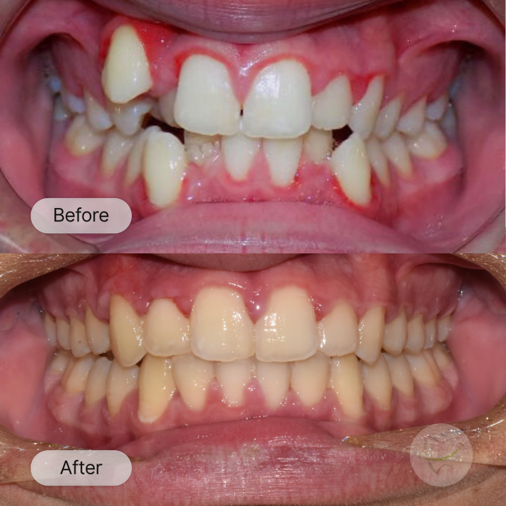 Ross Braces In Liberty Dental after 8-12 months
