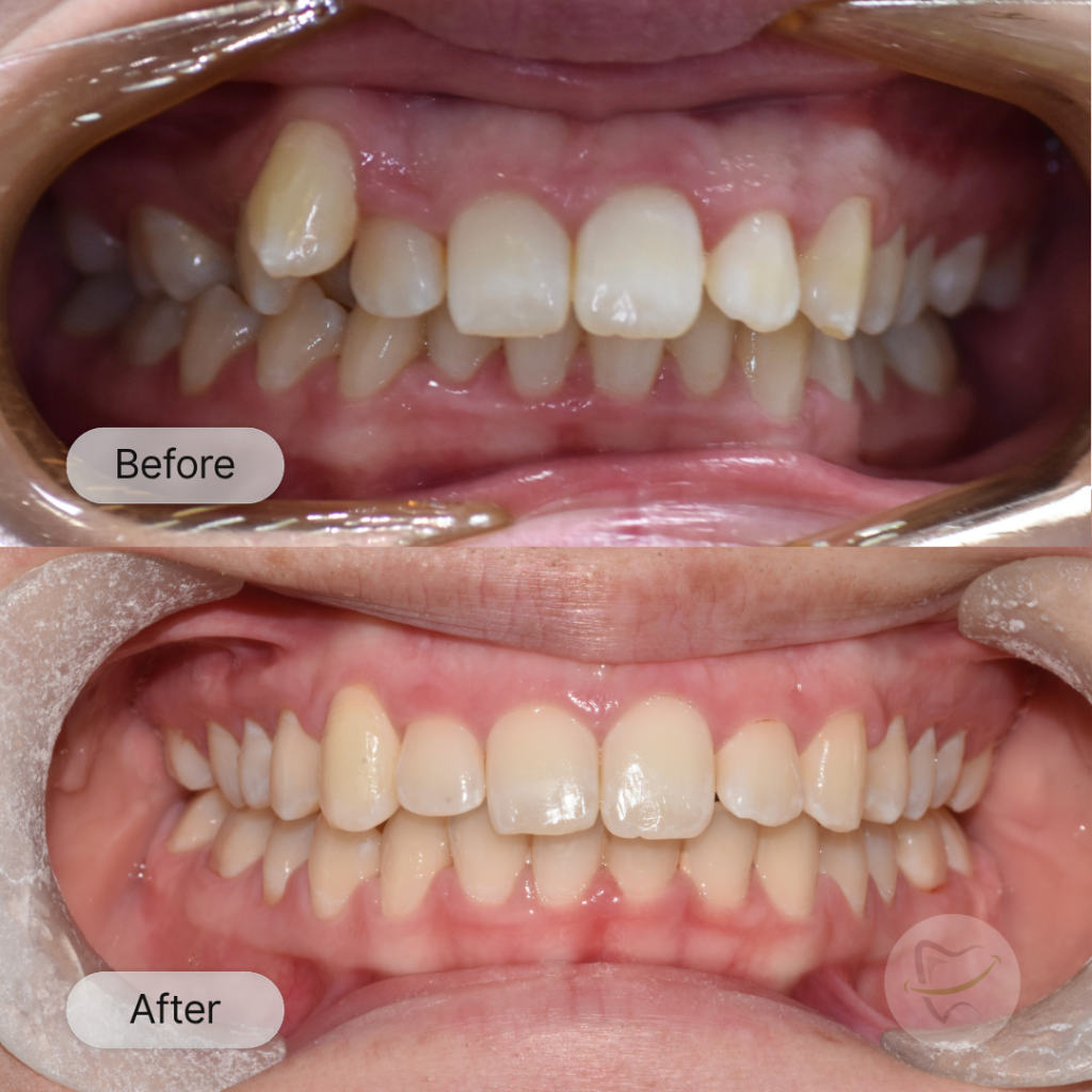 Coshams Braces In Liberty Dental after 8-12 months