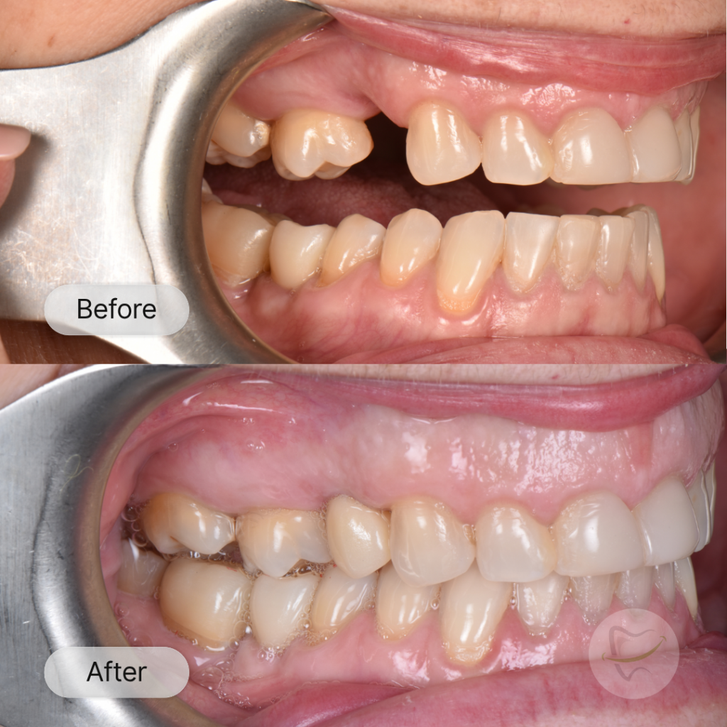 SD Implant In Liberty Dental after 12-15 weeks