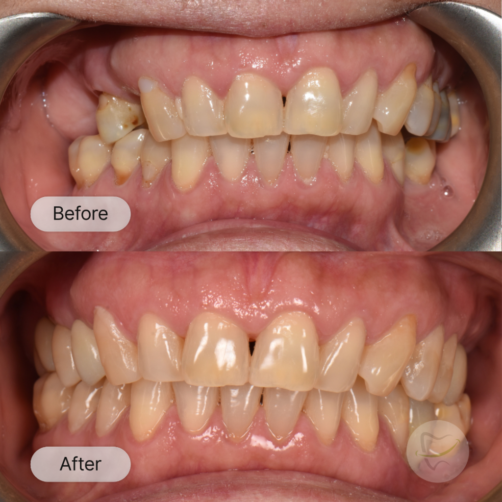 SL Implant In Liberty Dental after 12-15 weeks