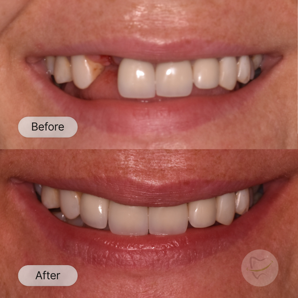 SR Implant In Liberty Dental after 12-15 weeks
