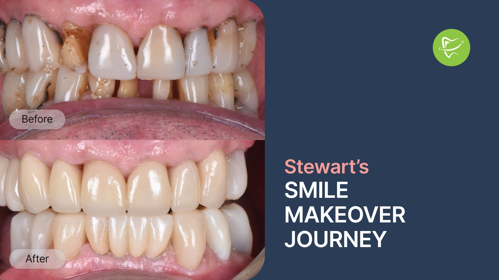 Smile Restoration After Years of Wear: How Stewart from Mount Waverley Restored His Smile with Porcelain Veneers and Zirconia Bridge at Liberty Dental
