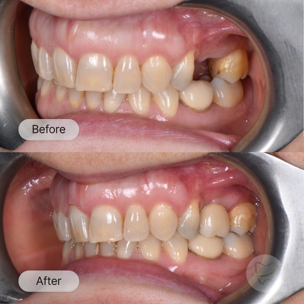 TM: implant after 12 weeks