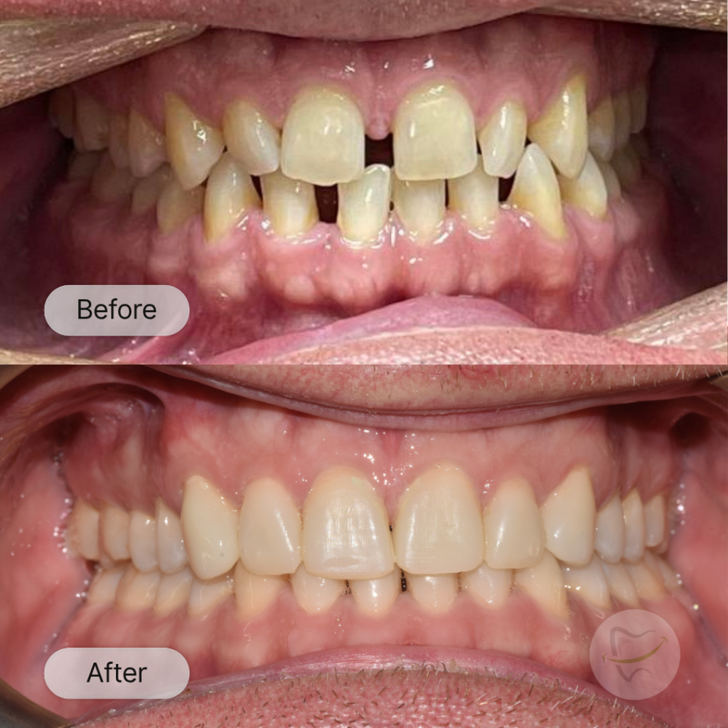 TH: Invisalign and Veneers, after 21 months