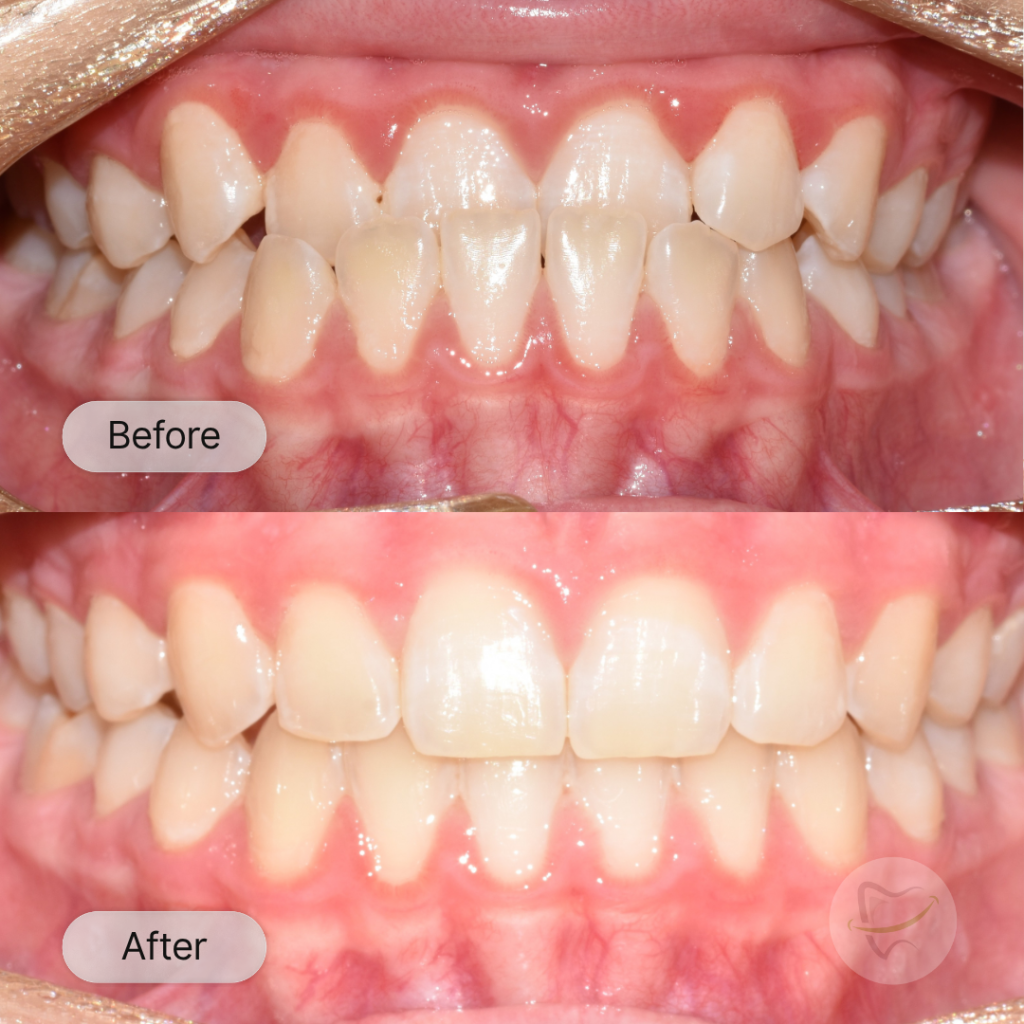 Taylah Moons Braces In Liberty Dental after 8-12 months