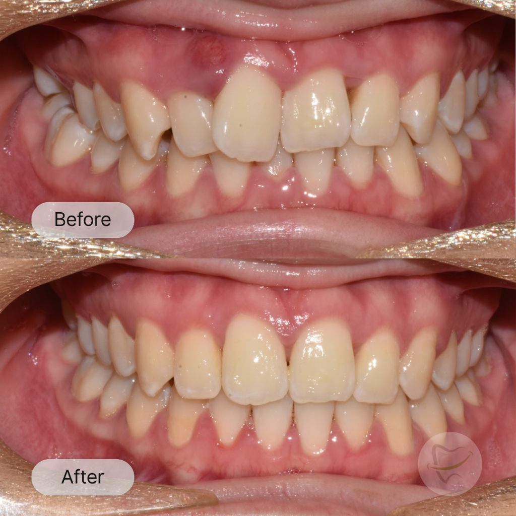 Theresa Braces In Liberty Dental after 8-12 months