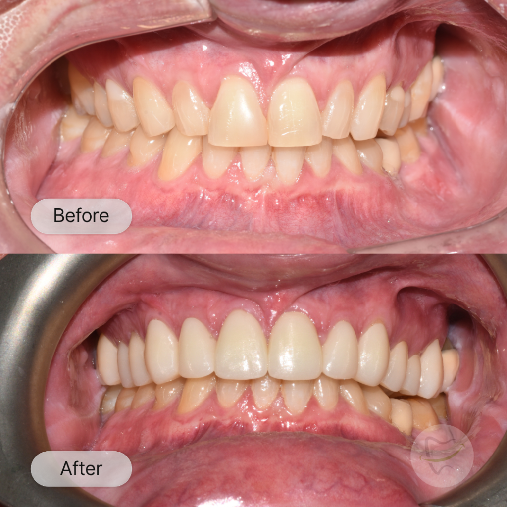 Tom Upper Smile Makeover In Liberty Dental after 12-15 weeks