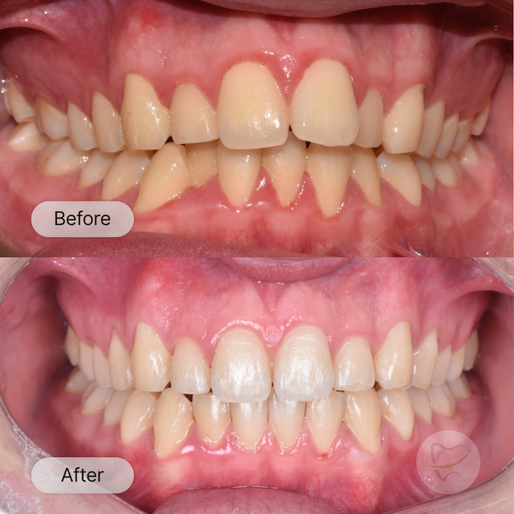 Tyler: Invisalign, after 17 months