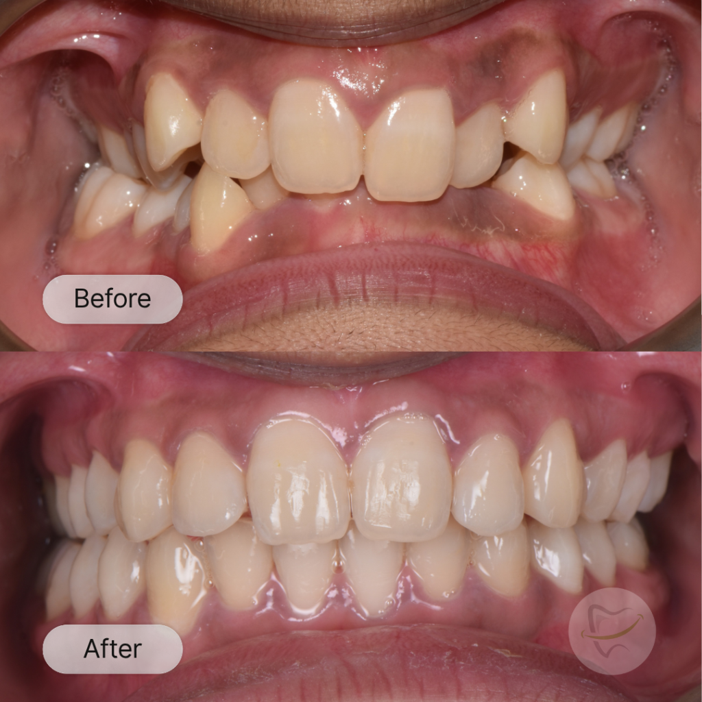 VS Braces In Liberty Dental after 8-12 months