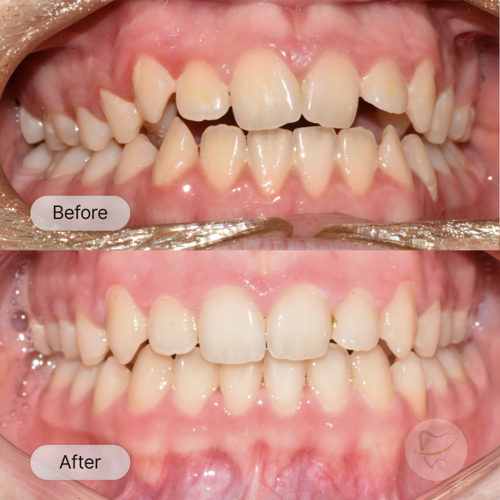 Victoria Braces & Laser Gum In Liberty Dental after 8-12 months