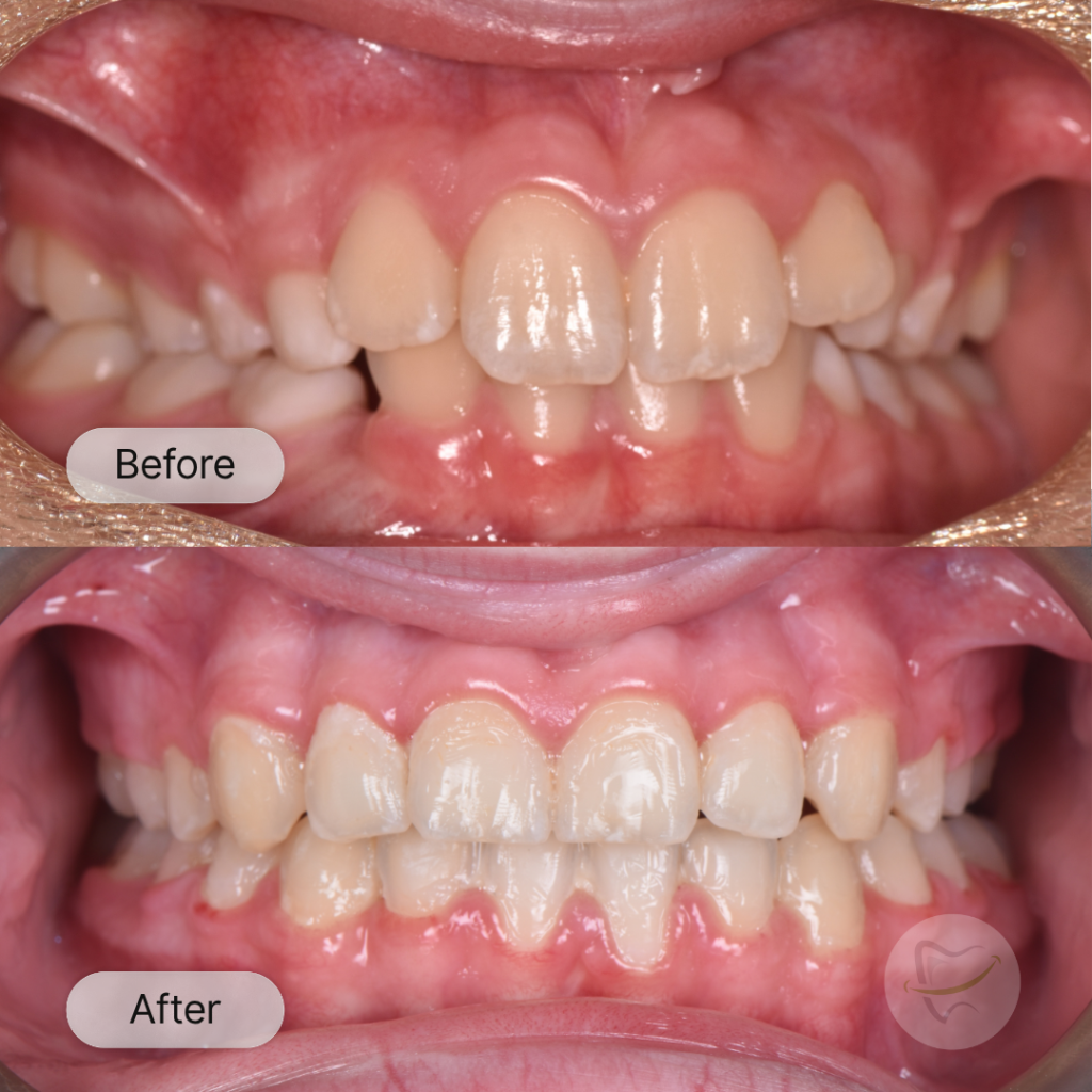 Zara Braces In Liberty Dental after 8-12 months