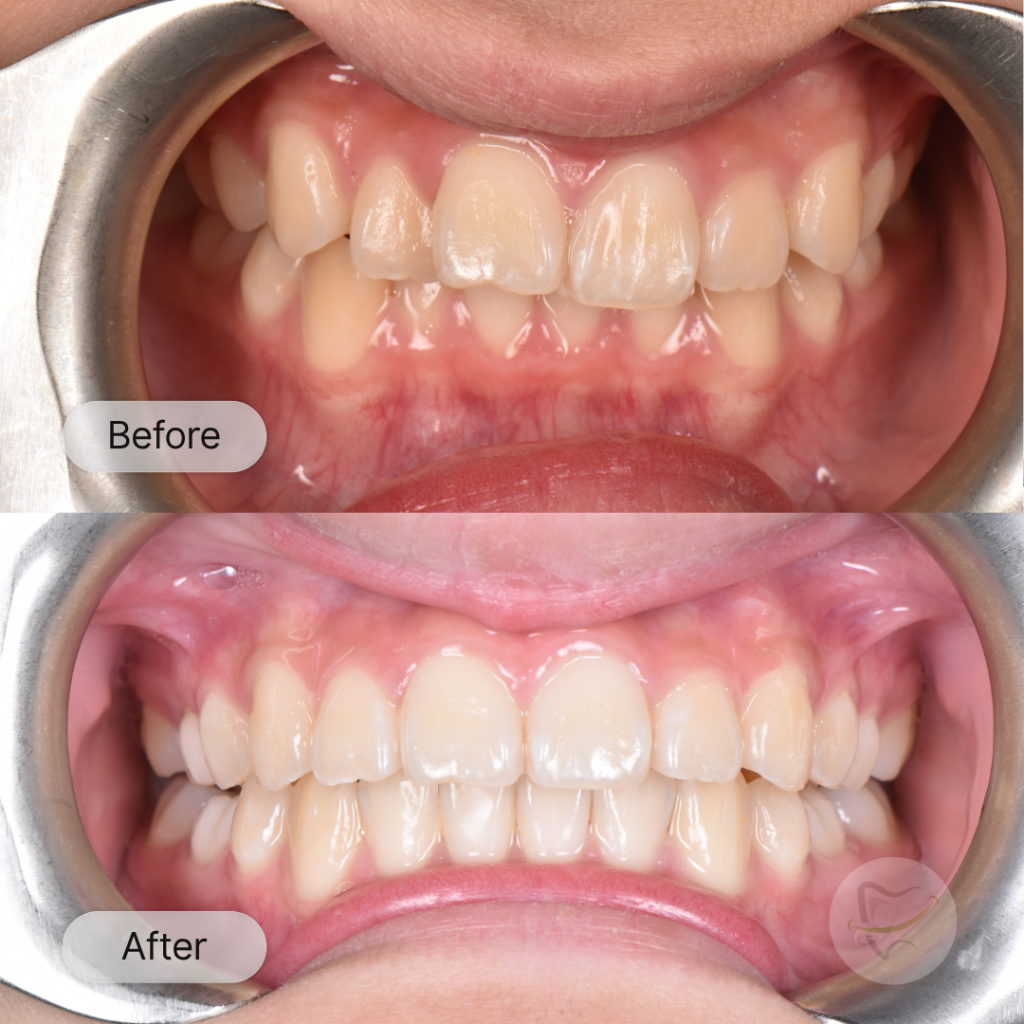 Zoe: Invisalign, after 12 months
