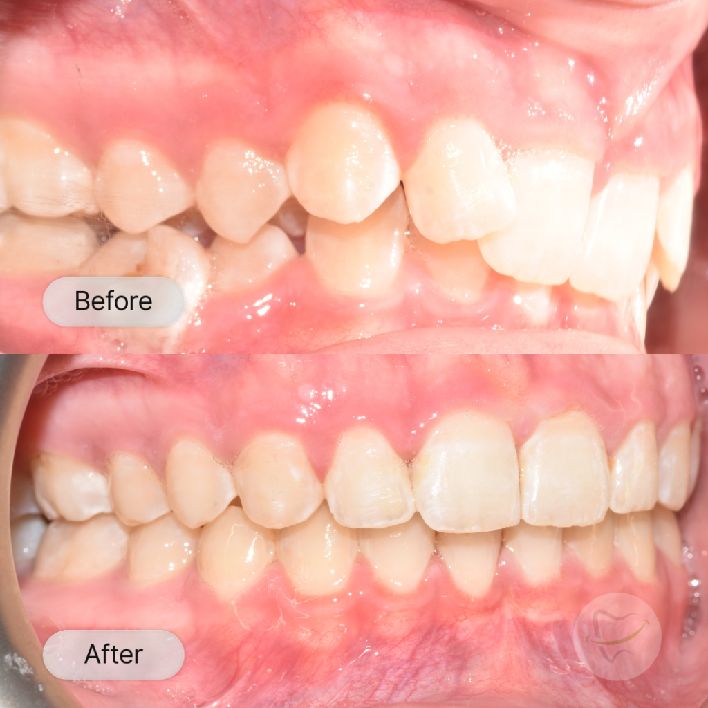 Imogen Braces In Liberty Dental after 8-12 months