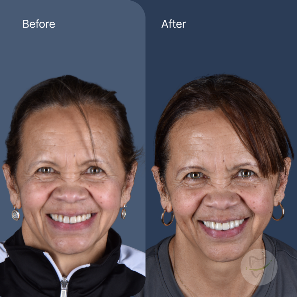 Linda-Ts-Veneers-at-Liberty-Dental