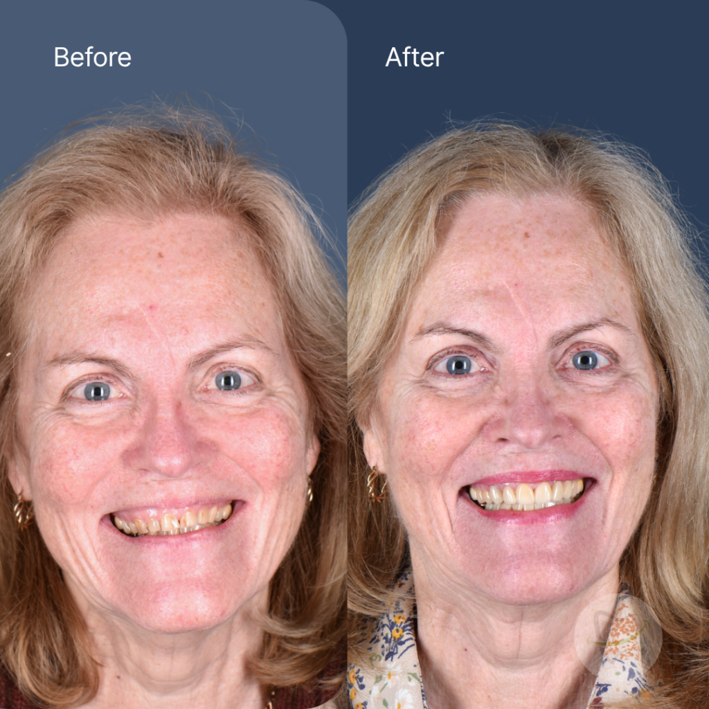 Marina Cs Full Mouth Rehab Treatment at Liberty Dental