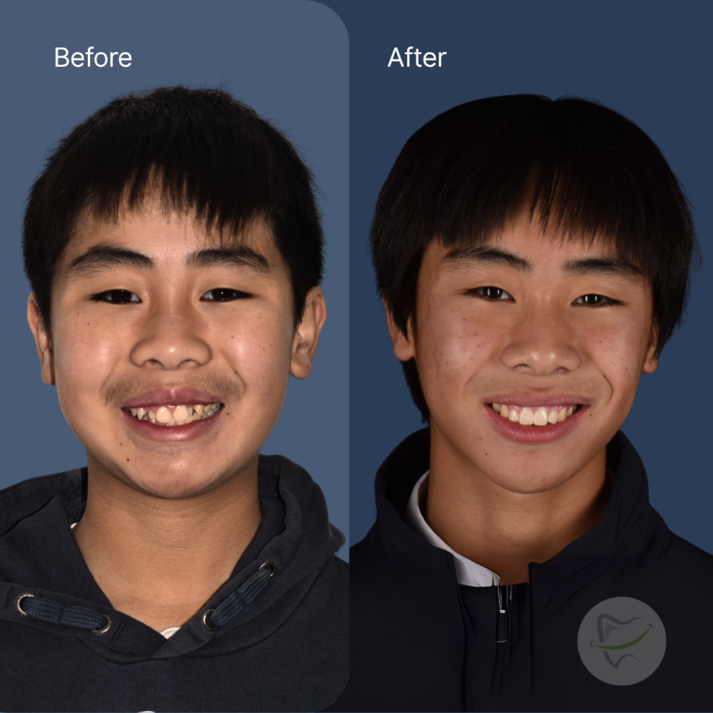 Raymond Braces In Liberty Dental after 8-12 months