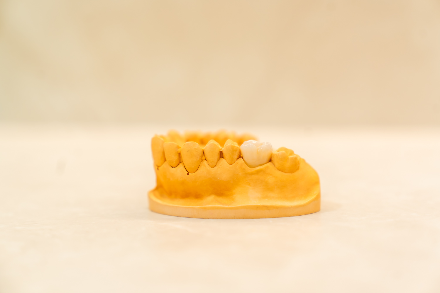 The Honest Guide to Affordable Dental Implants in Wheelers Hill